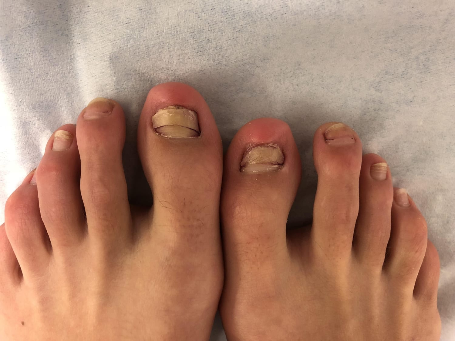 Horizontal nail ridges